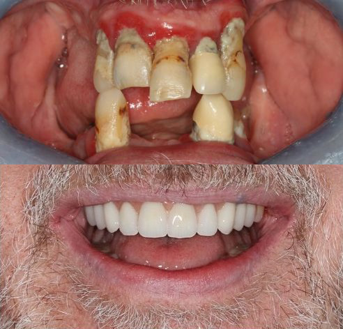 broken, missing and unhealthy teeth before smile in a day treatment at Total Dental Care